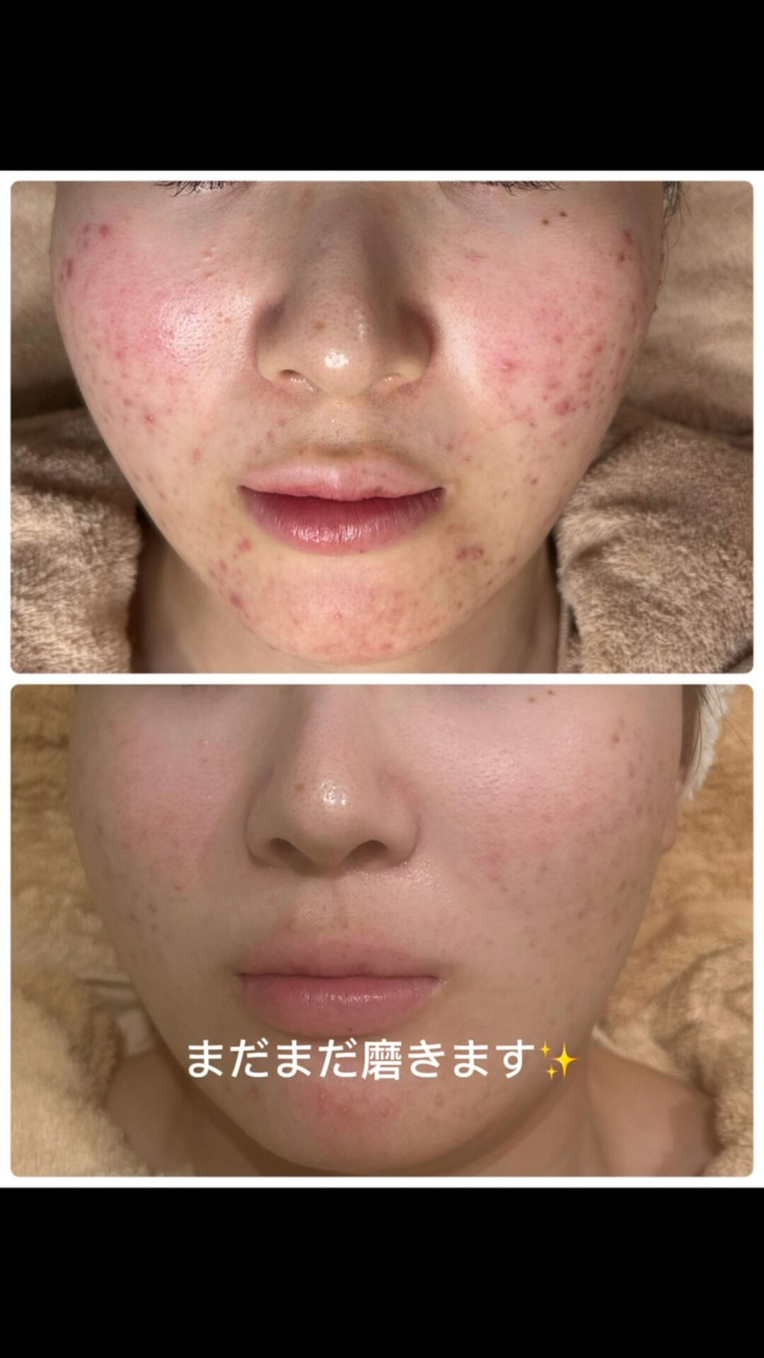 ✨ニキビ肌 Before → After✨